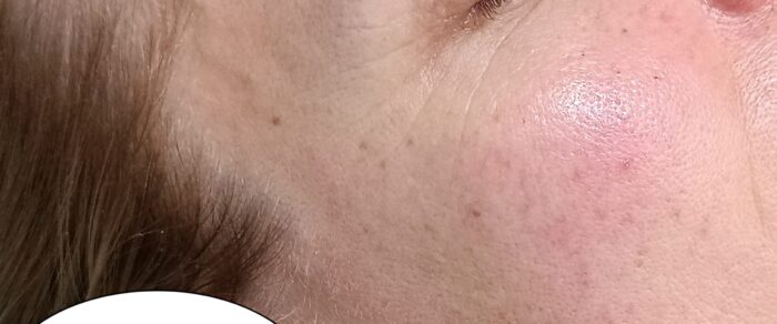 Age Proteom Eye Lift utána – kisimultabb, feszesebb szemkörnyék a kezelés után