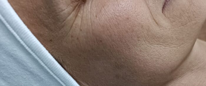 Age Proteom Eye Lift előtte – ráncos, fáradt szemkörnyék a kezelés előtt