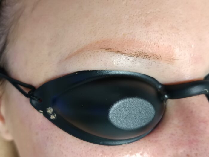 Lézeres tetoválás eltávolítás előtte – szemkörnyék a kezelés megkezdése után