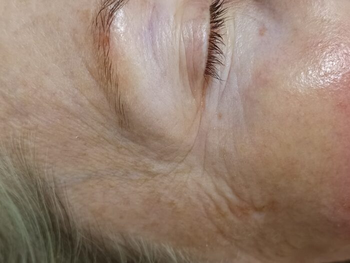 Age Proteom Eye Lift utána – kisimultabb, feszesebb szemkörnyék a kezelés után