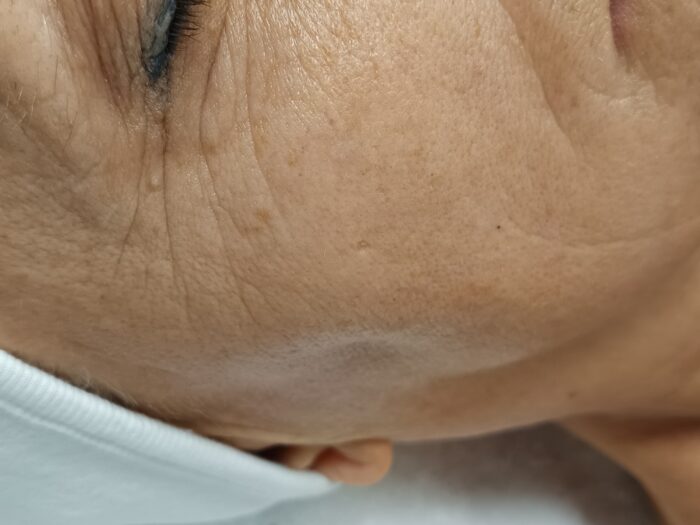 Age Proteom Eye Lift előtte – ráncos, fáradt szemkörnyék a kezelés előtt